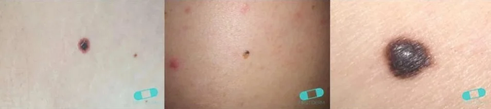 Three clinical photographs of melanoma skin lesions on light skin validated by FirstDerm dermatologists, showing varying sizes and pigmentation of suspicious moles